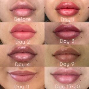 Lip Filler vs. Lip Flip vs. Lip Blushing