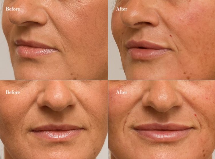 EVERYTHING you need to know about dermal fillers!